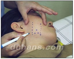 [Duhan Plastic Surgery Clinic Aesthetic Procedures] - [Square Jaw Botox] image 10