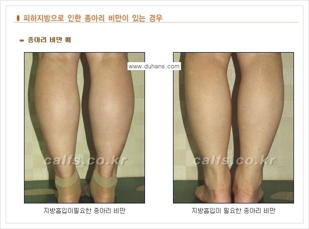 [두한성형외과 경쟁력 멀티종아리성형] - [나에게 맞는 종아리성형 방법의 종류 안내 2.] 관련 이미지 7