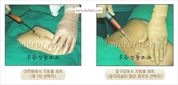 [두한성형외과 경쟁력 안면윤곽 교정] - [자연스럽고 균형있는 턱으로의 복원 미세지방이식과 간편 사각턱 보톡스 안내] 관련 이미지 28