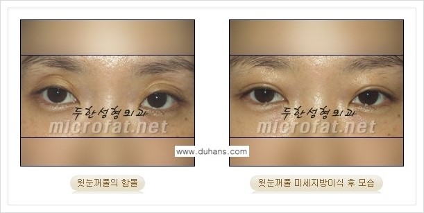 [두한성형외과의 경쟁력 미세지방이식] - [꺼진 눈꺼풀(윗눈꺼풀 함몰) 미세지방이식 안내] 관련 이미지 2