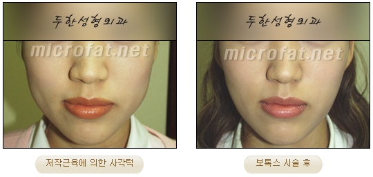 [두한성형외과 보톡스] - [사각턱 보톡스 시술 안내] 관련 이미지 17
