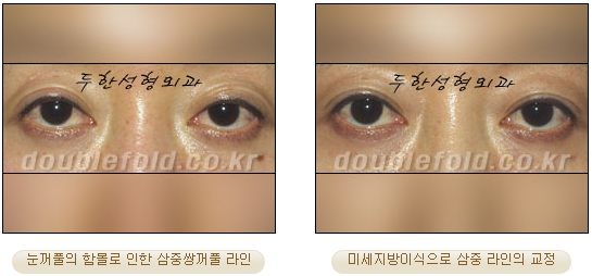 [두한성형외과 눈재수술] - [지방이식과 쌍꺼풀재수술 동시에 하는 경우] 관련 이미지 38