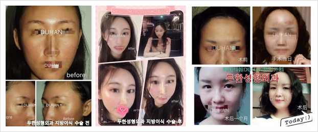 [두한성형외과 얼굴지방이식] - [미간주름] 관련 이미지 1