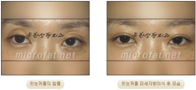 [Doohan Plastic Surgery Autologous Fat Grafting] - [Sunken Eye Fat Grafting] image 29