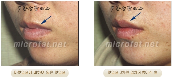 [Duhan Plastic Surgery Lip Surgery] - [Lip Correction Fat Grafting] image 18