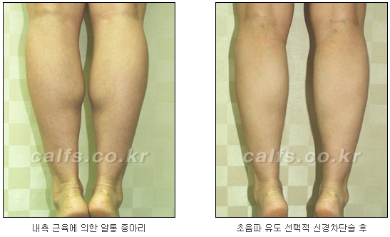 [두한성형외과 종아리퇴축술] - [NO절개! 초음파유도신경차단술] 관련 이미지 22