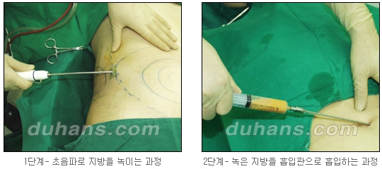 [Duhan Plastic Surgery Simple Liposuction] - [Liposuction for Obesity] image 8