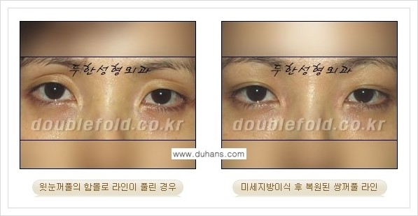 [두한성형외과 경쟁력 쌍꺼풀 재수술, 극한 재수술] - [미세지방이식으로 풀린 쌍꺼풀 교정] 관련 이미지 5