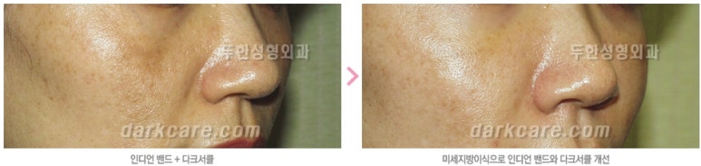 [두한성형외과 자가지방이식] - [인디언주름] 관련 이미지 30