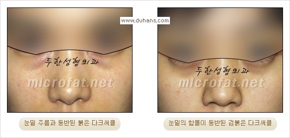 [두한성형외과 경쟁력 눈밑성형] - [Dr. 컬럼 - 눈밑 다크써클의 치료 방법과 치료 효과] 관련 이미지 15