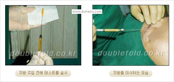 [두한성형외과 경쟁력 눈성형] - [삼중(세겹) 쌍꺼풀 라인의 교정] 관련 이미지 15