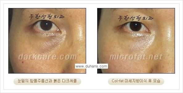 [두한성형외과 경쟁력 눈밑성형] - [눈밑 다크써클과 눈밑 함몰주름의 최적화 교정방법 안내] 관련 이미지 32