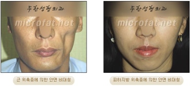 얼굴지방이식 두한성형외과 - 볼지방이식 관련 이미지 4