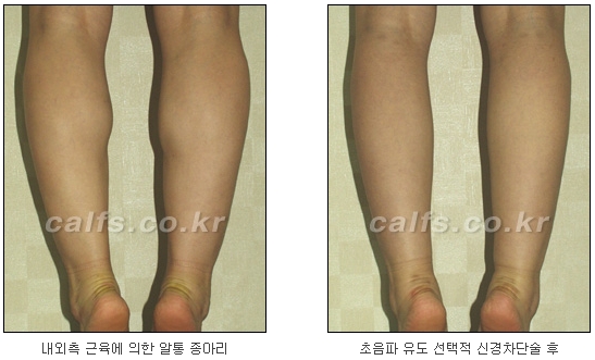 [두한성형외과 종아리퇴축술] - [NO절개! 초음파유도신경차단술] 관련 이미지 33