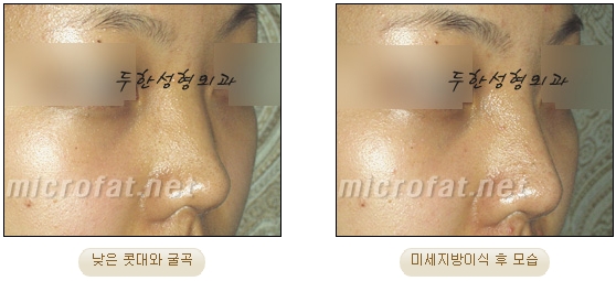[두한성형외과 지방이식] - [지방이식을 이용한 코성형] 관련 이미지 21