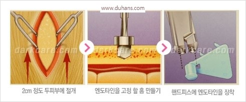 [두한성형외과 경쟁력 주름성형] - [주름제거와 볼륨을 갖게하는 엔도타인 리프팅] 관련 이미지 18