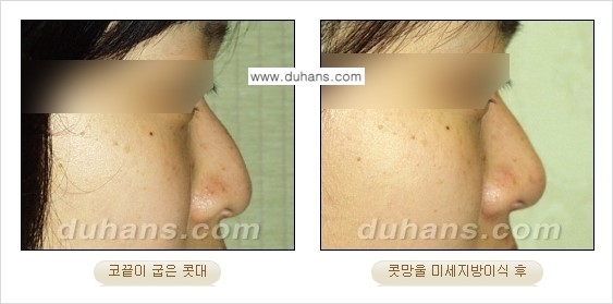 [두한성형외과 경쟁력 미세지방이식] - [코 지방이식 2.] 관련 이미지 8