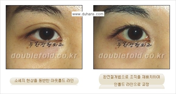 [두한성형외과] - [아웃폴드를 인폴드로 변화시키는 쌍꺼풀재수술] 관련 이미지 10