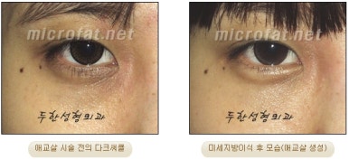 두한성형외과 눈밑성형 - 애교필러 후 눈밑재수술 관련 이미지 40