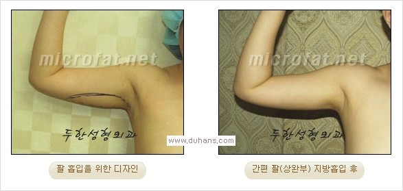 [두한성형외과 경쟁력 지방흡입] - [초음파 지방흡입과 미세흡입관을 이용한 간편지방흡입] 관련 이미지 5