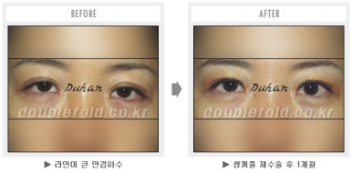 두한성형외과 쌍커풀 재수술 - 짝눈 눈매교정, 가성 안검하수 교정과 뒤밑트임 관련 이미지 59