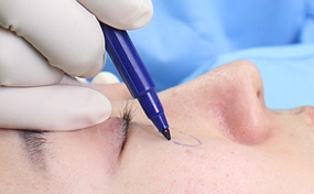 [Duhan Plastic Surgery Dark Circles] - [Under-Eye Dark Circle 5-Step Solution] image 8