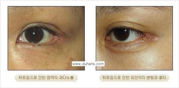 [두한성형외과 경쟁력 쌍꺼풀 재수술, 극한 눈재수술] - [뒤트임 교정 안내] 관련 이미지 1