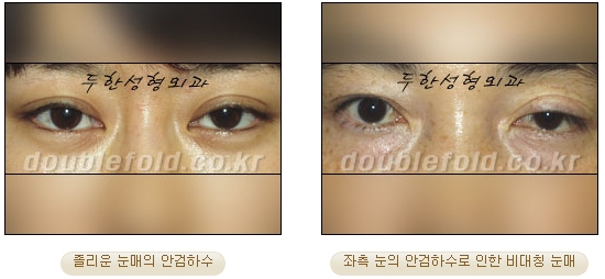 [Duhan Plastic Surgery Double Eyelid Revision Surgery] - [Ptosis, sausage eyelids] image 2