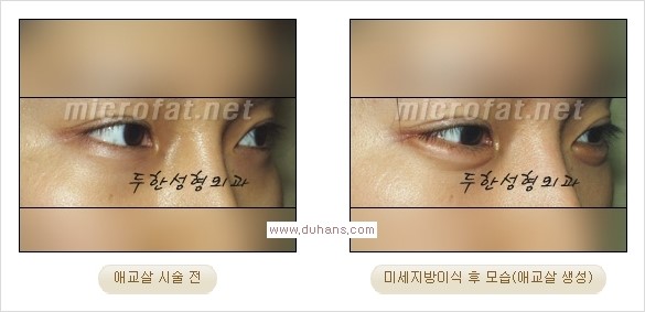 [두한성형외과 경쟁력 눈밑성형] - [타 병원 필러 애교살 시술 부작용을 미세지방이식으로 교정] 관련 이미지 20