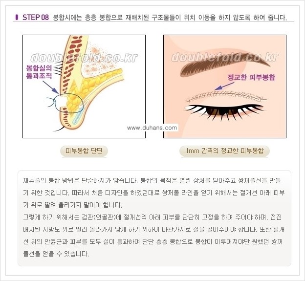 [두한성형외과 경쟁력 쌍꺼풀 재수술, 극한 재수술] - [쌍꺼풀 재수술의 과정 안내 1.] 관련 이미지 8
