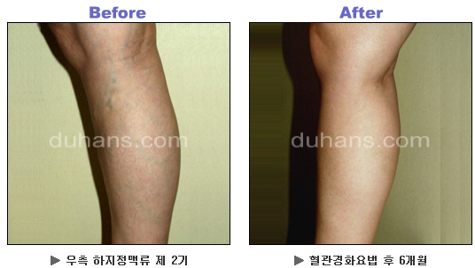 [두한성형외과 정맥류] - [하지정맥류, 정맥확장증, 혈관확장증] 관련 이미지 20
