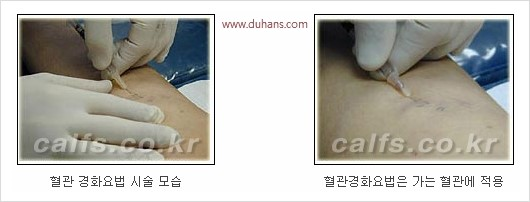 [두한성형외과 경쟁력 종아리성형 리더] - [종아리 성형 안내] 관련 이미지 18