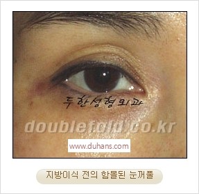 [두한성형외과 경쟁력 쌍꺼풀 재수술 리더] - [풀린 쌍꺼풀, 풀려버린 쌍꺼풀 재수술 방법 안내] 관련 이미지 11