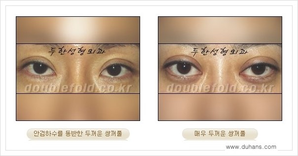 [두한성형외과 경쟁력 쌍꺼풀 재수술] - [두껍고 어색한 라인 교정하는 방법 안내 2.] 관련 이미지 1