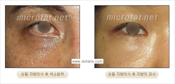 [두한성형외과 경쟁력 미세지방이식] - [타병원에서의 미세지방이식 이후 부작용 교정의 대상 안내] 관련 이미지 7