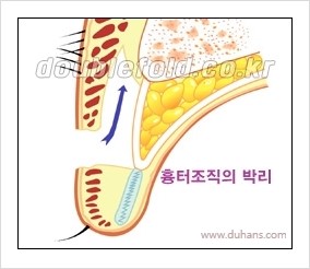 [두한성형외과 경쟁력 눈성형] - [쌍꺼풀 재수술 실패의 원인과 문제점] 관련 이미지 2