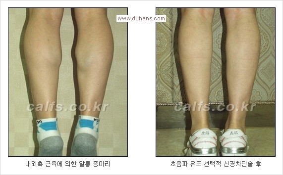 [두한성형외과 Dr. 컬럼] - [종아리 근육퇴축술로 가장 선호하는 비절개 초음파 유도 선택적 신경차단술] 관련 이미지 13
