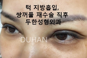 [두한성형외과 쌍커풀재수술] - [개인의 눈매와 특성에 맞는 쌍커풀재수술] 관련 이미지 5