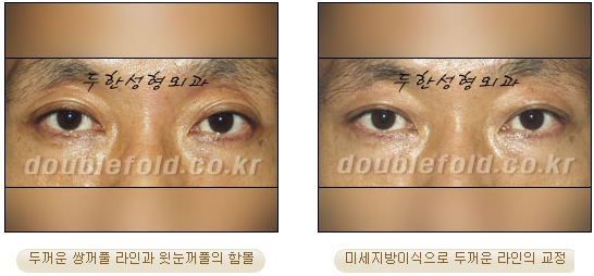 [두한성형외과 쌍커풀수술] - [눈성형 방법에 대한 자주하는 질문과 답변] 관련 이미지 88