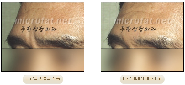 [두한성형외과 미세지방이식] - [자가지방이식] 관련 이미지 9