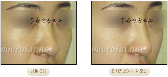 [두한성형외과 지방이식] - [지방이식을 이용한 코성형] 관련 이미지 15