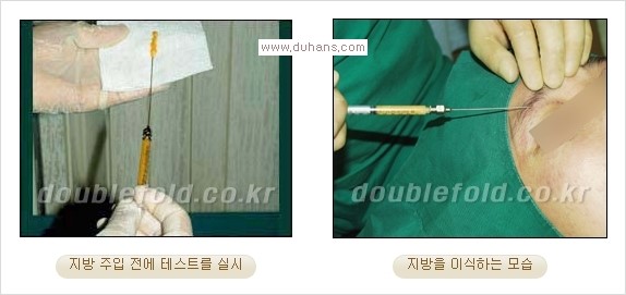 ​⁠⁠[두한성형외과 경쟁력 쌍꺼풀 재수술, 극한 눈재수술] - [지방이식으로 눈매와 쌍꺼풀 라인을 교정] 관련 이미지 6