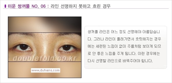 [두한성형외과 경쟁력 눈성형] - [나에게 맞는 맞춤 쌍꺼풀 찾기] 관련 이미지 6