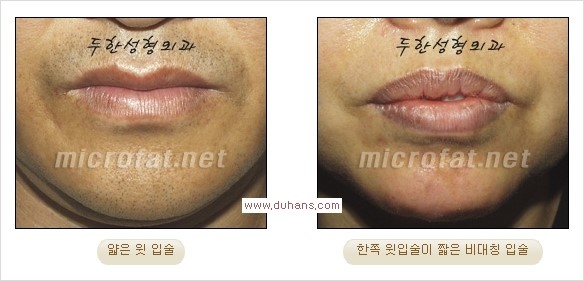 [두한성형외과 경쟁력 미세지방이식] - [입술 3차원 입체지방이식 안내 1.] 관련 이미지 2