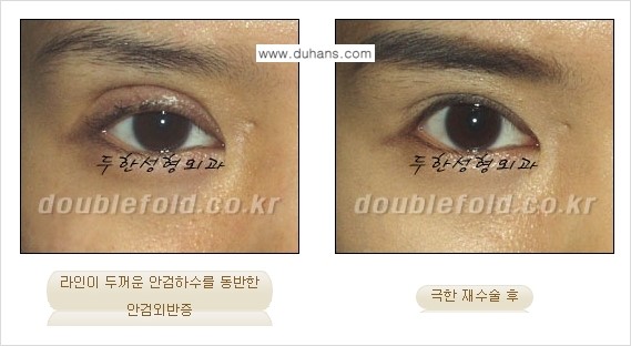 [두한성형외과 경쟁력 눈성형] - [재수술시 유의해야 할 사항과 성공 요건] 관련 이미지 7