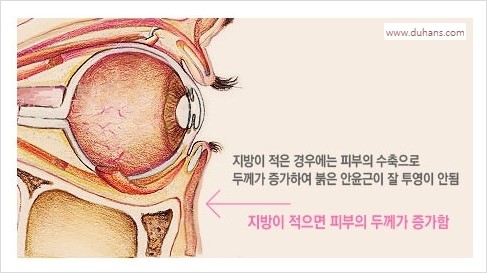 [두한성형외과 경쟁력 눈밑성형] - [눈밑 안와지방 돌출의 무통마취 무흉터 눈밑지방제거 안내] 관련 이미지 4