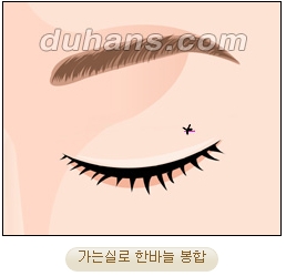 두한성형외과 지방제거 - 눈밑지방, 눈꺼풀지방제거 관련 이미지 9