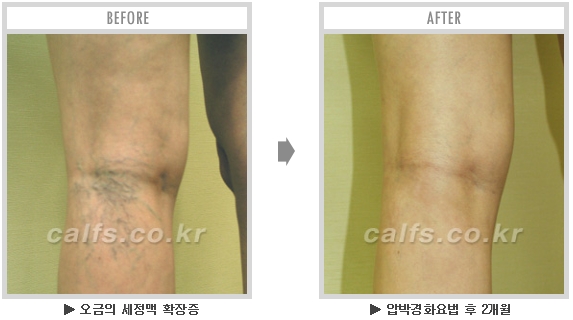 [종아리성형 두한성형외과] - [종아리수술에 대한 자주하는 질문과 답변 모음] 관련 이미지 26