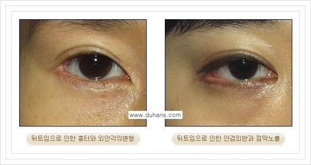 [두한성형외과 경쟁력 쌍꺼풀 재수술, 극한 재수술] - [뒤트임 수술에 대한 안내] 관련 이미지 4