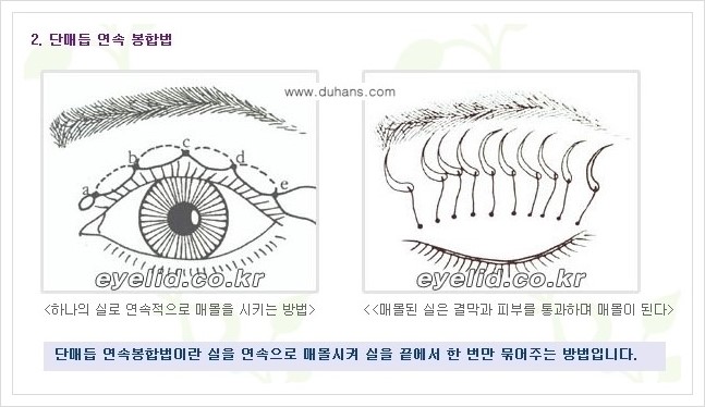 [두한성형외과 경쟁력 눈성형] - [절개법, 매몰법 쌍꺼풀 수술 안내] 관련 이미지 5